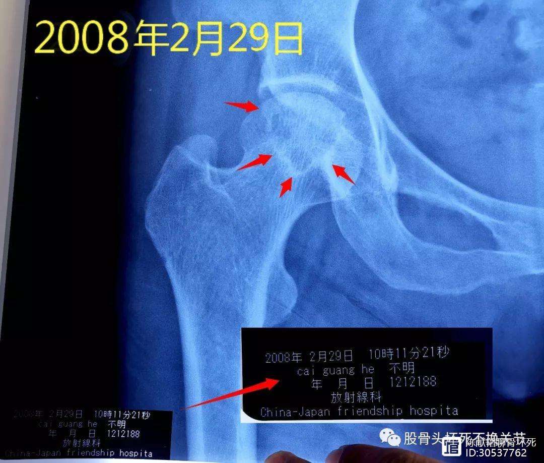 安徽人工骨头医保报销多少(人工骨头医保报销多少比例)