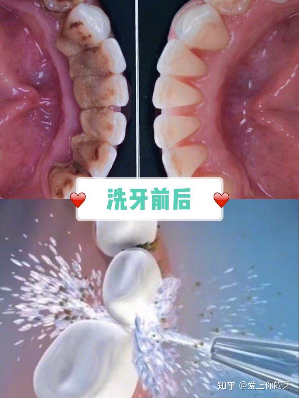 安徽洗牙可以用医保吗(洗牙可以用医保吗,报销比例多少)